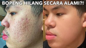 Read more about the article Bekas Jerawat Rahasia Memudarkan Secara Alami Dari Bopeng ke Glowing
