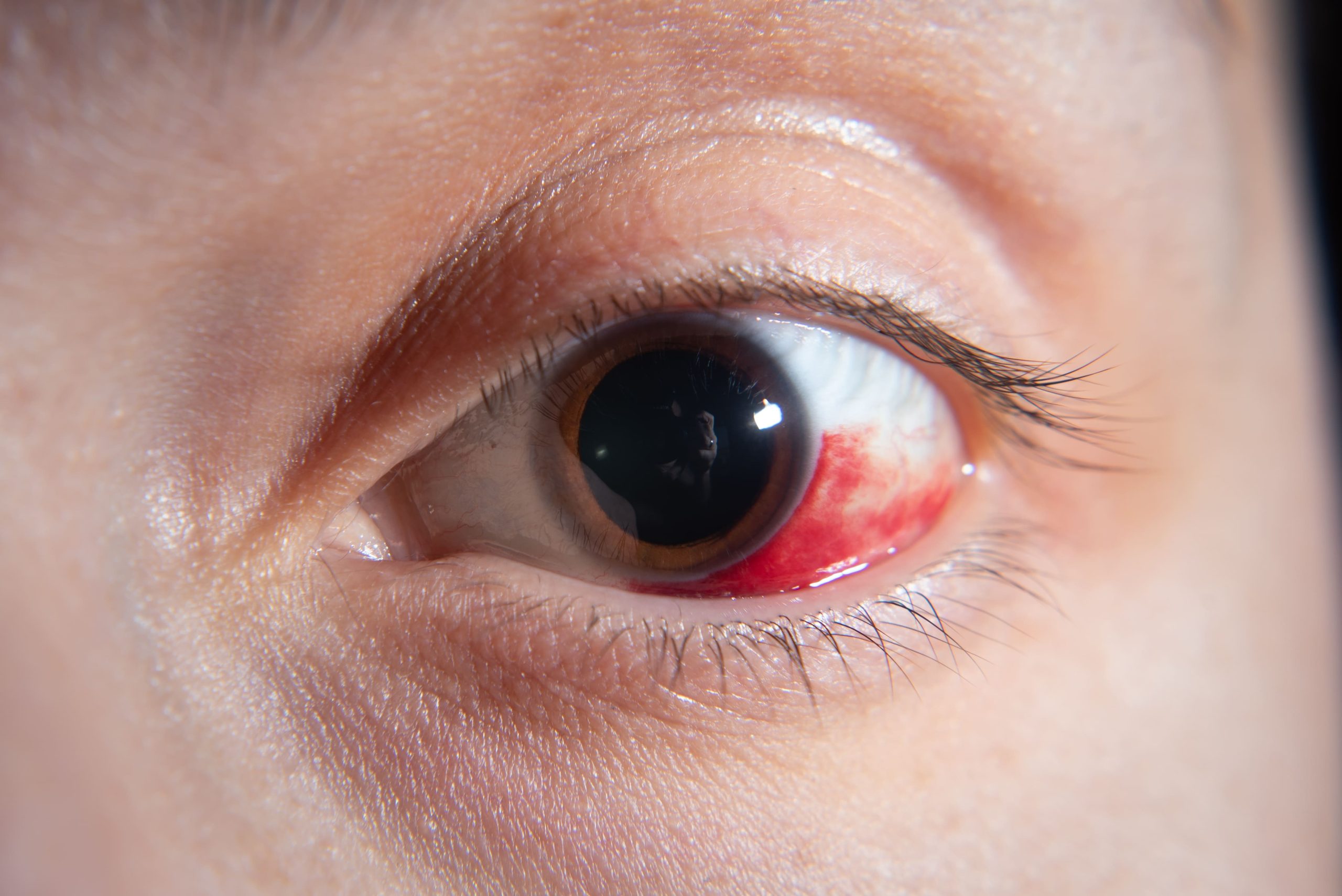 gejala Ablasi Retina