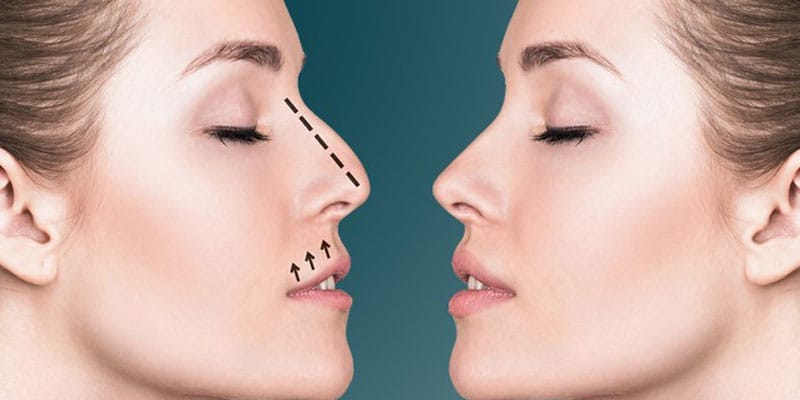 Rhinoplasty 