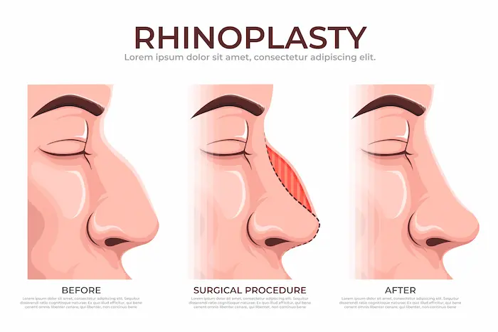 You are currently viewing Rhinoplasty hingga Facelift dalam Dunia Estetika Masa Kini